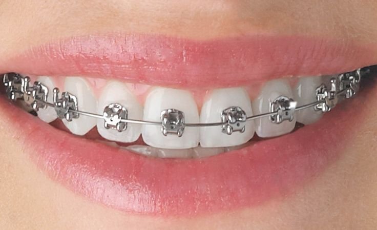 Braces Treatment in New Sangavi