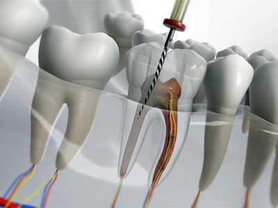 Root Canal Treatment